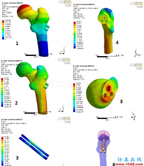 “倒品字”與“品字”空心釘不同Pauwels分型骨折的生物力學(xué)性能研討ansys仿真分析圖片4