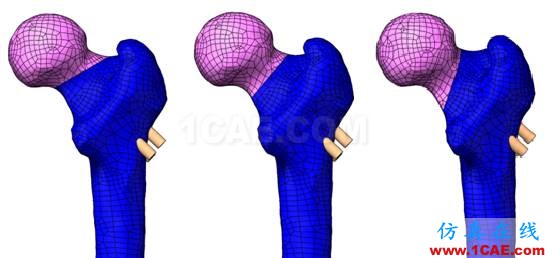 “倒品字”與“品字”空心釘不同Pauwels分型骨折的生物力學(xué)性能研討ansys仿真分析圖片3