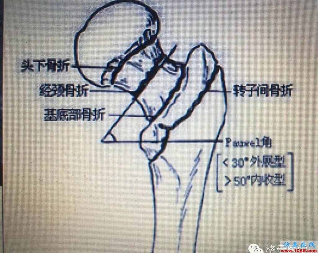 “倒品字”與“品字”空心釘不同Pauwels分型骨折的生物力學(xué)性能研討ansys仿真分析圖片2